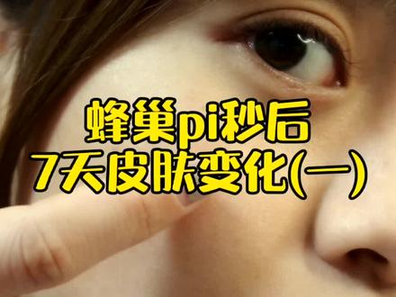 #护肤 #美容 #祛斑 #皮秒 蜂巢pi妙后7天皮肤变化(一)