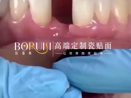 “马里兰桥”修复,减少磨牙痛苦!