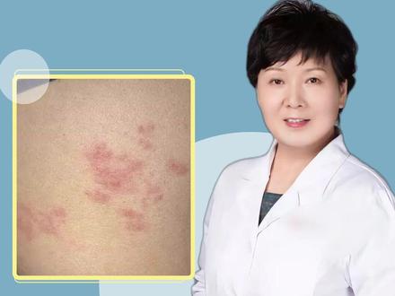 得了带状疱疹能洗澡吗? #皮肤问题
