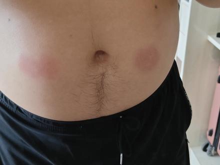 替尔泊肽第三针和第四针好像都过敏了,前两针一点事没有 是体质变了吗