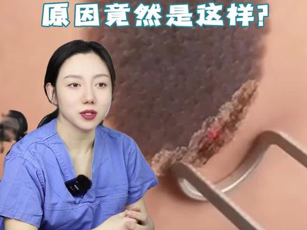 宝宝长胎记是怎么回事呢?和宝妈有关系吗?#胎记宝宝 #胎记 #孕期