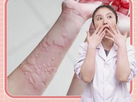 身上突然出现大块大块的风团特别痒,越抓还越多,可能是#急性荨麻疹 ,教你这样处理,最后一点很重要! #荨麻疹 #医学科普