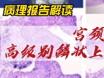 宫颈高级别鳞状上皮内病变,病理报告解读