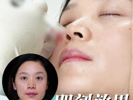 泪沟注射术后即刻效果
#泪沟 #泪沟凹陷 #郑州注射医生 #胶原蛋白 #玻尿酸