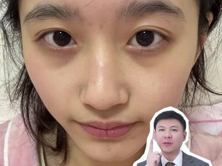 3种类型黑眼圈如何改善? #黑眼圈 #眼周抗衰 #泪沟 #抗衰