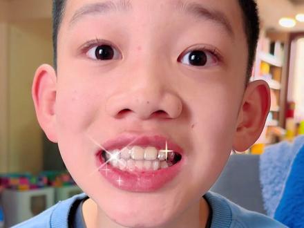 小赵牙齿半年后的变化 #正畸#整牙#时代天使