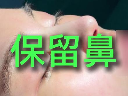 直鼻微翘术后讲解 #张鹏保留鼻 #隆鼻 #鼻子 #直鼻微翘 #初鼻