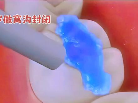 很多家长不知道,窝沟封闭是预防孩子蛀牙最省事、最有效的办法。
到底几岁做最合适,今天一次性说清楚。#一口好牙的重要性 #整牙历程 #儿童口腔护理 #给儿童拔牙的小妙招
