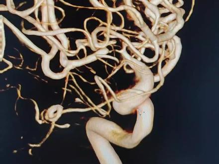 该脑梗死患者正规双抗➕他汀口服仍然反复TIA发作,CTP提示右侧额颞叶脑组织灌注不足,造影查出病因是脑血管重度狭窄,经过微创手术球囊扩张,患者血管恢复如初,病人目前恢复的棒棒的。(不是每个患者都适合做这个手术,手术效果因人而异)#医学科普