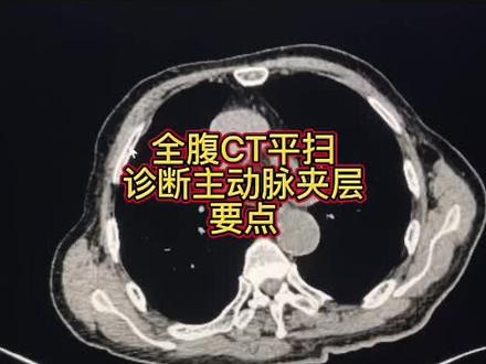 早期作品之平扫上诊断主动脉夹层要点 #主动脉夹层
