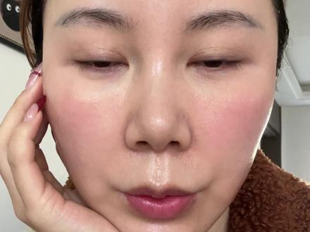 酸后13天,脸上的皮还没掉完!#刷酸 #刷酸必备 #玫瑰脂皮