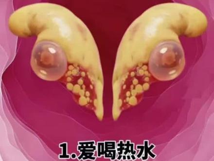 ##脑梗#脑梗塞#RedHalo脑力源胶囊