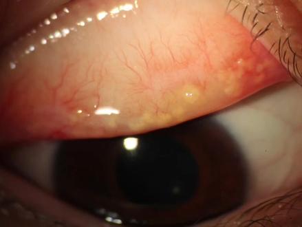 看图识病之结膜结石#印象最深的门诊故事 #兔年开工健康指南 #眼科科普 #结膜炎 #徐医附院眼科王贺