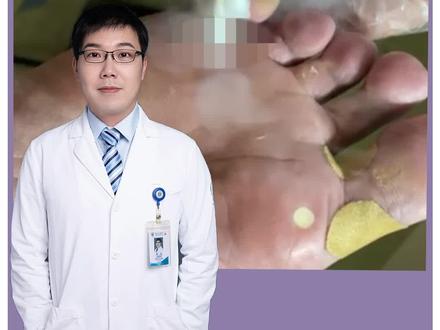 液氮冷冻到底有多痛?一起来体验一下~#樊哥撩皮肤 #液氮冷冻 #鸡眼 #医学科普