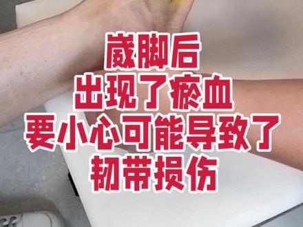 崴脚后,出现了瘀血,要小心,可能导致了韧带损伤#崴脚#踝关节扭伤 #瘀血 #距腓前韧带断裂 #戴医生聊足踝