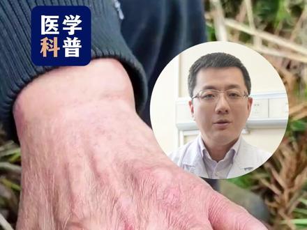 最新研究,痛风石溶解再也不是梦 #痛风 #痛风石 ##痛风石可以溶解了 #告别痛风石 #抖出健康知识宝藏