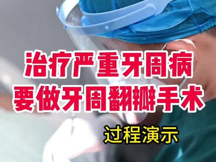 牙周翻瓣手术是治疗严重牙周病的重要手段。希望你爱护好牙齿别走到这一步。#牙周炎 #牙周病 #口腔科普 #牙医日常 #牙科@抖音医疗健康小助手