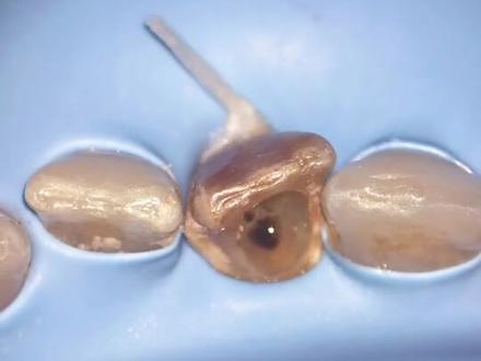 去年做的根尖屏障,欢迎牙医朋友们提出宝贵意见