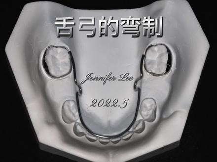弓丝弯制之-舌弓的弯制-下颌间隙保持器
舌弓式间隙保持器:将舌弓的两端固定在第二乳磨牙或第一恒磨牙上,以保持下颌牙弓周长的固定式间隙保持器。多用于下颌乳牙列及混合牙列期多个牙的早失。通常在下颌切牙萌出后使用,以免影响其萌出。
#弓丝弯制 #华文正畸俞银杰
ps:视频来源-Jennifer阿JUAN
仅分享正畸实用技巧,如有冒犯,请第一时间私信删除