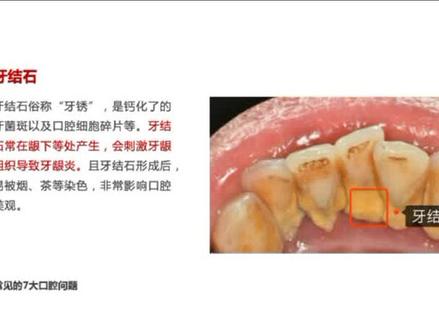 常见的牙齿问题和诱因,你的牙齿健康吗?