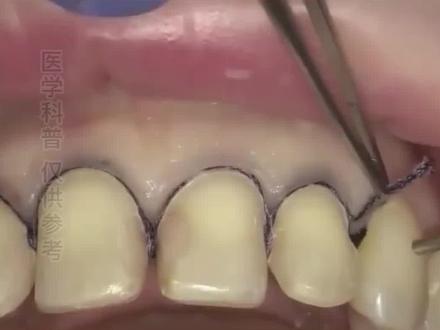 戴牙冠前,往牙龈塞根线是做什么?有人知道吗?
#口腔健康 #排龈线 #全瓷冠 #牙齿健康