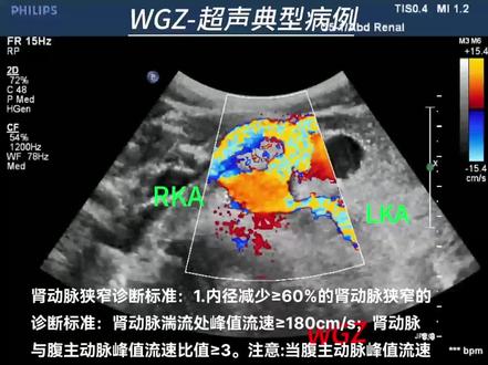 肾动脉狭窄超声声像图#超声学习 #超声影像典型案例 #b超 #超声影像 #高血压