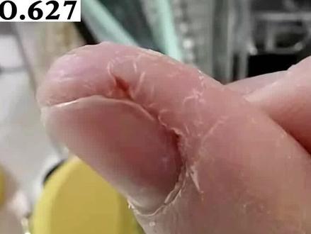 一到冬天手指头就干裂起皮,这样处理好得快,建议把视频分享给你另一半看#湿疹 #皮肤 #科普 #糠酸莫米松凝胶