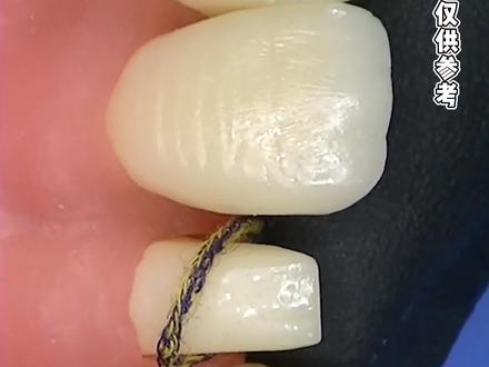 排龈线在修复工作结束后就会取出来啦,不用担心#牙冠 #牙贴面 #排龈线