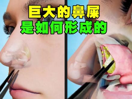 巨大的鼻屎是如何形成的?