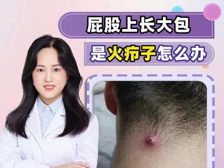 你屁股上长了这种大包吗?#疖肿 #皮肤健康 #医学科普