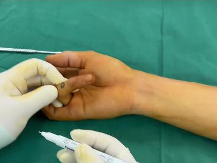 #腱鞘巨细胞瘤 #软组织肿瘤 #腱鞘巨细胞瘤切除
肢体软组织肿瘤复杂多样,术前很难得到确诊,需要依靠术后病理检查。但术前辅助检查可以提示良恶性、病变层次、侵犯组织、与重要组织的毗邻关系等内容,为规划治疗提供依据。腱鞘巨细胞瘤是少有的术前可明确诊断的肢体软组织病变,发现病变早点切除、首次手术尽可能彻底切除对于预防复发有帮助。