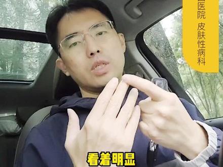 为啥小朋友手足口之后会出现脱甲症?应该怎么处理?#脱甲症 #手足口 #川崎病