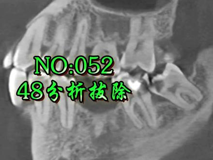 看视频涨经验#口腔健康 #医学影像 #拔智齿