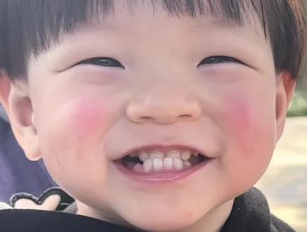 反颌矫正历时五个月成功上岸✌️#反颌矫正地包天#整牙历程 #牙齿反颌矫正器 #一口好牙 #最治愈的笑