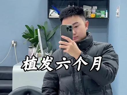 #上热门 #M型发际线 #植发