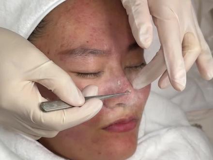 毛孔里塞满油脂粒,每天洗脸但总感觉脸上还是油乎乎的,大油皮看过来,怎么做毛孔深层清洁,让你的毛孔自由呼吸#油痘肌#闭闭口口#毛孔清洁#商丘祛痘#护肤