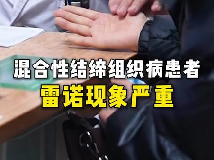 混合性结缔组织病患者雷诺现象严重 #混合性结缔组织病 #雷诺现象 #平安风湿科王晓军 #抖出健康知识宝藏 #健康科普不基础