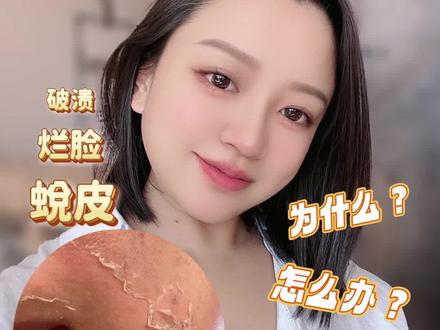 酸疗后为什么会蜕皮⁉️会不会烂脸⁉️如何应对⁉️#美容院 #皮肤管理 #刷酸 #护肤 #美业人