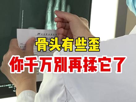 喜欢把手指关节按压弹响的人注意了!小心手指变歪,造成关节损伤! #手外科 #指关节
