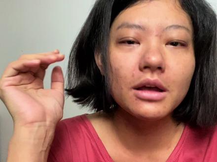 看涨水8斤的小仙浮肿脸,相当于3天没尿尿,以后再也不会肿成这样