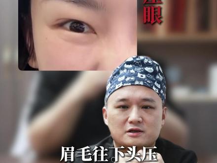打了肉毒出现了“眉压眼”的情况
#肉毒 #知识科普 #衡力 #保妥适 #眉压眼