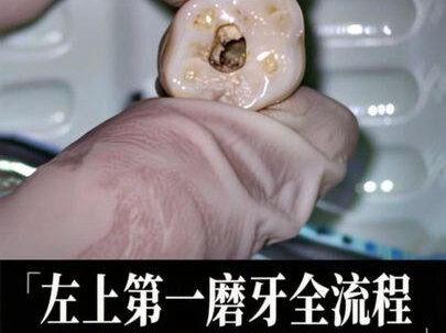 根管治疗全流程#有趣的知识又增长了 #行业大揭秘 #口腔健康 #根管治疗 #牙齿