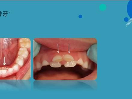 孩子出现双排牙的原因,家长看了大吃一惊!