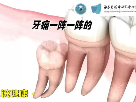牙痛一阵一阵的是什么原因#牙痛#口腔科普