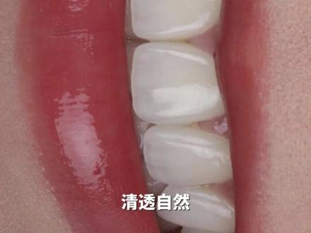 白鹿春晚的牙齿贴面#春晚 #白鹿 #牙齿贴面 #全瓷贴面