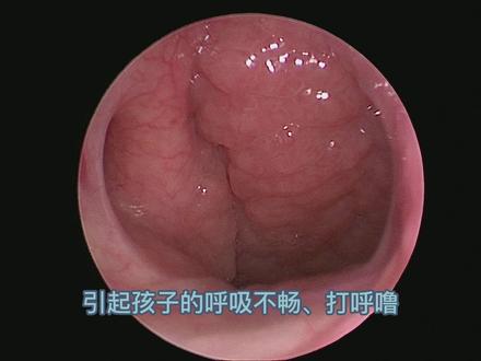 近年新秀
腺样体
#医学科普 #健康科普 #科普健康知识 #科普一下