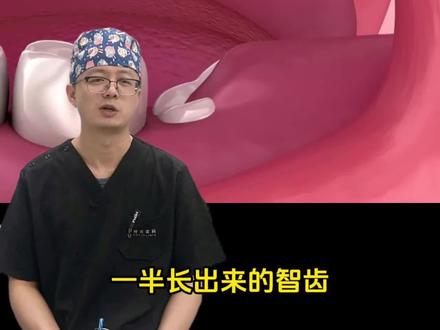 一半长在肉里一半长出来的智齿需要拔吗 #智齿 #牙齿 #拔牙 #抖出健康知识宝藏