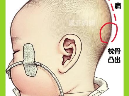 降颅顶的方法#新生儿护理 #头型 #圆头 #婴儿头型到底怎么睡 #高颅顶