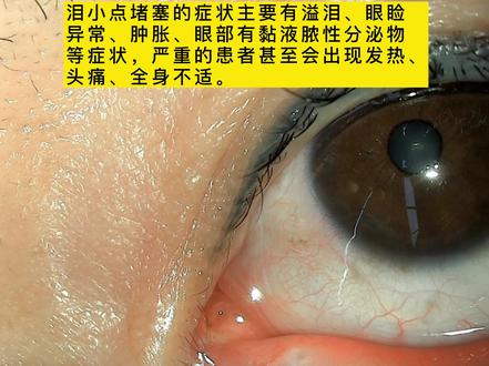 泪道疏通手术#泪道手术 #泪道堵塞 #泪道探通术 #泪小洞