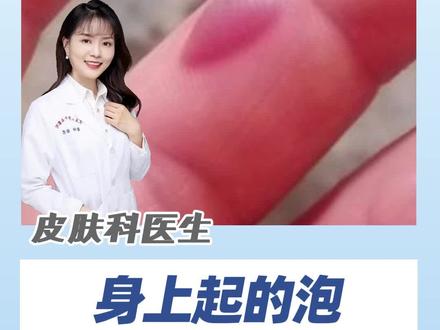 谁说身上起的泡 都不能弄破的?#健康科普 #医学科普 #皮肤科 #水泡